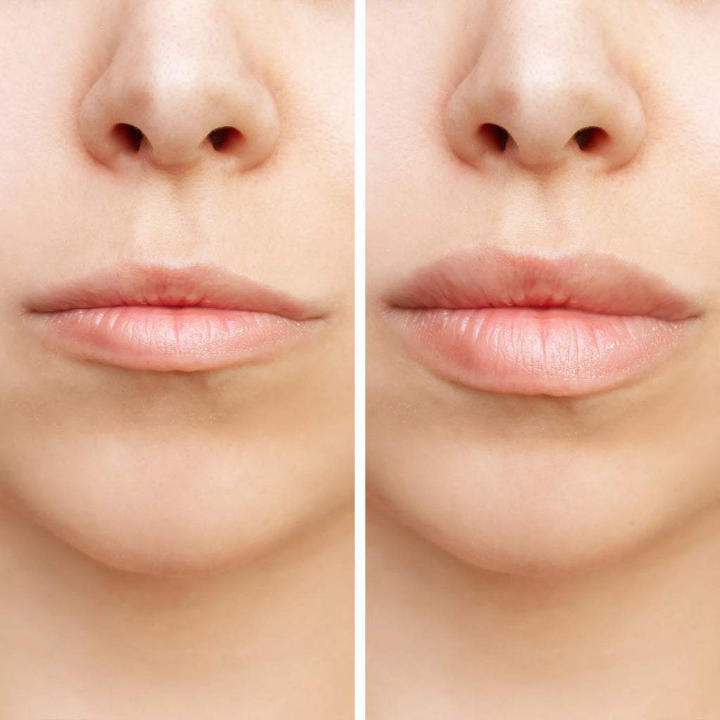 Lips Filler